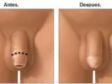 Antes y después de la circuncisión.
