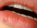 Ejemplo de un herpes labial.