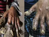 Las manos de Abul Bajandar, conocido como el 'hombre árbol', antes y después de las operaciones en sus manos.