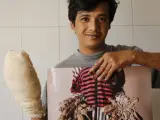 Abul Bajandar, conocido como el 'hombre árbol', muestra una fotografía de cómo estaban sus manos antes de someterse a 16 operaciones en el Dacca Medical College, en Bangladesh.