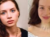 Lorna Nickson, a la izquierda en una foto con un bulto en su garganta y a la derecha, tras operarse.