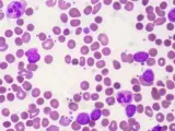 Células de Leucemia linfática crónica (LLC) en una imagen de archivo.