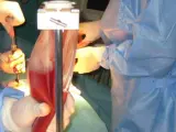 Técnica de extracción de médula ósea en quirófano.