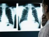 El cáncer de pulmón puede manifestarse de diferentes maneras.