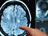 Imagen de una radiografía de un cerebro tras sufrir un derrame.