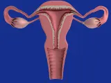 La mayor complicación derivada del VPH es el cñancer de cuello de útero. Afortunadamente, es poco frecuente.