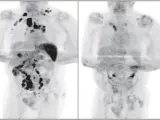 Comparación de la tomografía por emisión de positrones (PET) al inicio (izquierda) y después de meses infectado con SARS-CoV-2 (derecha).