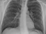 Radiografía torácica de un paciente con sarcoidosis pulmonar.