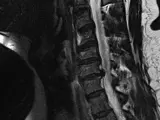 Imagen tomada por resonancia magnética de una lesión en la médula espinal de un ser humano.