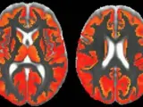 Dos imágenes del cerebro por resonancia magnética ponderada.