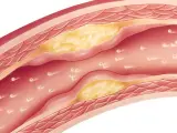 Imagen de archivo. Adherencias en las arterias, colesterol. Estatinas