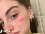 Imagen del nuevo reto de moda en TikTok, 'la cicatriz francesa'.