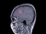 Resonancia magnética y meningioma