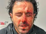 Fabio Grosso, ensangrentado tras ser herido en el ataque de los ultras del Marsella.
