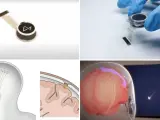 Un robot coloca quirúrgicamente los hilos ultrafinos y flexibles del implante N1 en una región del cerebro que controla la intención del movimiento.