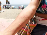 Una mujer muestra su brazo tras sufrir una picadura de una medusa.